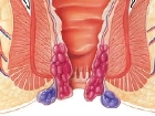 Hemoroid Hastalnda Devrim