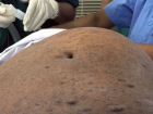 Hindistanl� Kad�n�n Karn�ndan 7 Kg A��rl���nda T�m�r ��kar�ld�