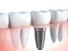 �mplant�n Amac� Nedir, Neden Yap�l�r?