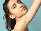 �ngiliz Foto�raf�� �nsanlar�n V�cutlar�ndaki Kapanmayan Yara �zlerini G�r�nt�ledi