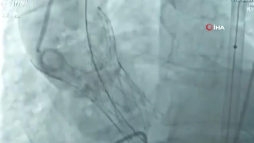 Irakl hastann kalp kapa ameliyatsz deitirildi