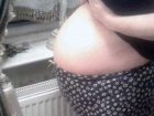 �rritabl Ba��rsak Sendromuna Yakaland�, Karn�ndan Devasa Kitle ��kt�