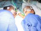 İsviçre'de 8 Günlük Yapışık İkizler Ameliyatla Ayrıldı