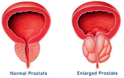 İyi Huylu Prostat Büyümesi (Bening Prostat Hiperplazisi)