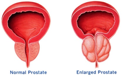 yi Huylu Prostat Bymesi (Bening Prostat Hiperplazisi)