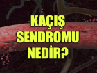 Ka��� sendromu nedir? Belirtileri nelerdir? Nas�l tedavi edilir?