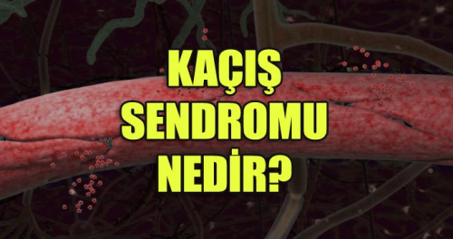 Ka sendromu nedir? Belirtileri nelerdir? Nasl tedavi edilir?