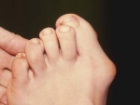 Kad�nlarda S�k g�r�len bir Ayak Sorunu; Halluks Valgus