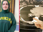 Kanser san�lan kad�n�n soluk borusundan badem zar� ��kar�ld�