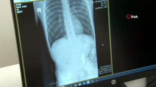 Karn arsyla hastaneye giden ocuun midesinden 42 adet mknats topu kt