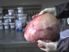 Karn�nda 6 Kilograml�k T�m�rle 8 Y�l Ya�ad�