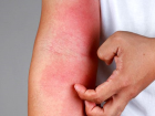 Ka��nt� deyip ge�meyin, Atopik Dermatit son y�llarda h�zla art�yor