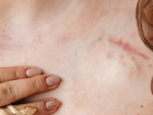 Keloid nedir, nas�l ge�er? Keloid hastal���n�n kesin ��z�m� var m�?