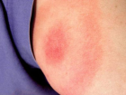Kene ile bula�an LYME Hastal��� Tehlikesi T�rkiye'de De Yayg�n Olabilir