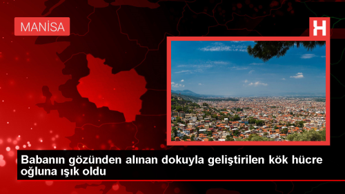 Lavabo acnn yzne sramas sonucu gzn kaybeden hasta, babasnn gznden alnan dokunun kk hcreyle tedavi edilmesiyle yeniden grme yetisine kavutu