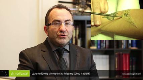 Lazerle Dvme Silme Sonras yileme Sreci Nasldr? - Op. Dr. Nuri Battal