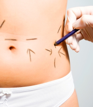 Liposuction Ne Zaman Yaptırılmalı?