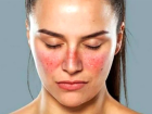 Lupus Hastal��� Nedir? Lupus Hastal���n�n Belirtileri Nelerdir?