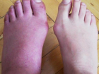 Makrodaktili hasatl��� nedir? Makrodaktili hastal���n�n belirtileri nelerdir?