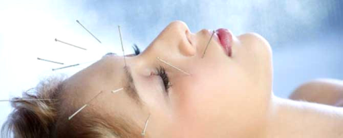 Migren Arlarna Akupunktur Engeli