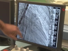 Mitral balon operasyonu ad�m ad�m kaydedildi