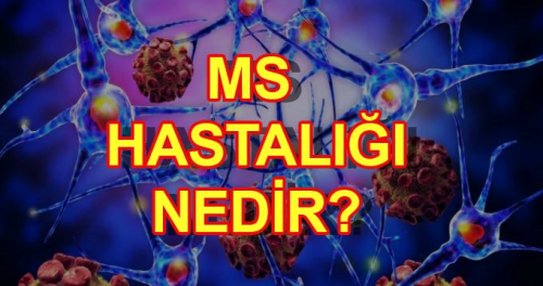 MS hastal nedir? Multiple Skleroz hastal belirtileri nelerdir?