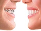 Ortodontik Tedavinin Faydaları Nelerdir?