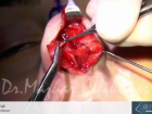 Rino-Nb-Final - Dr.rinoplasti - Op. Dr. Mazhar Çelikoyar