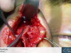 Rinoplasti Ameliyat� - Dr.rinoplasti - Op. Dr. Mazhar �elikoyar