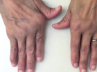 Romatoid Artrit Tedavisinde Kullan�lan �la� T�rkiye'de �retilecek