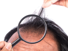 Saç Dökülmesi Bu Hastalıkların İşareti Olabilir