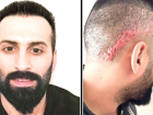 Sa Ektirmek stedi, Kafasnda Keloid Denilen Yara zi Olutu