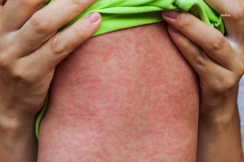 Sa�l�k Bakanl���, 81 il valili�ine k�zam�k vakalar�n�n artmas� nedeniyle genelge g�nderdi