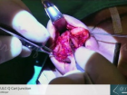 Sectioning Ulc-Q Cart Junction - Dr.rinoplasti - Op. Dr. Mazhar �elikoyar