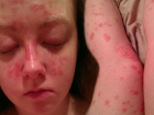 Sedef Hastal���ndan Kanser �lac�yla Kurtuldu