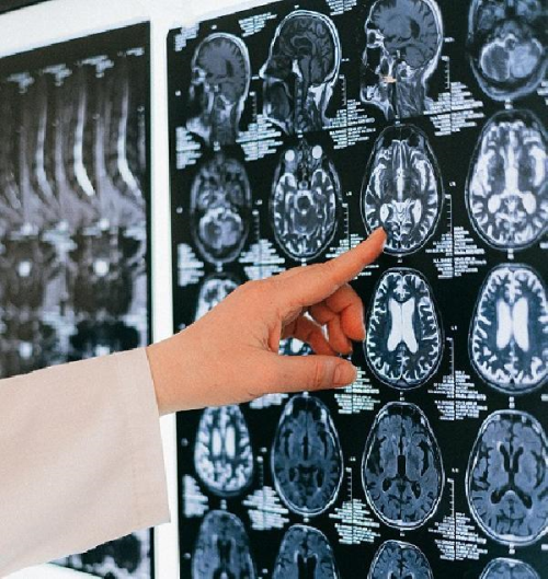 Serebral palsi; ocuklarda ilk 3 yaa dikkat