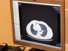 Sigara i�en 40 ya� �st� vatanda�lar i�in akci�er tomografisi �nemli