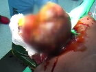 Somalili gen� 2 bu�uk kiloluk t�m�rden T�rkiye'de kurtuldu