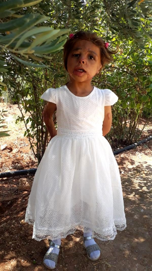 Son dakika haberleri! 5 ya��ndaki Suriyeli Hane'nin 'y�z�', T�rkiye'de g�lecek