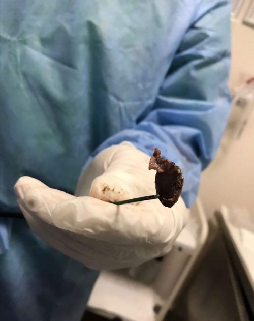 Son dakika haberleri: Karabk'te ksrk ikayetiyle hastaneye giden kadnn akcierinden ekirdek kt