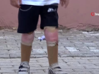 Suriyeli yetim Muhammed, kaybetti�i bacaklar�na T�rkiye'de kavu�tu