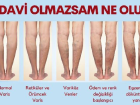Tedavi edilmeyen varise dikkat; mr boyu varis orab giymek zorunda kalabilirsiniz