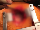 T�kal� 3 kalp damar� 8 santimlik kesiyle de�i�tirildi