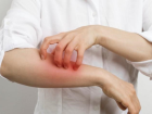 Uyuz belirtileri nedir? Uyuz belirtileri ne zaman ba�lar, ka� g�nde ortaya ��kar? Uyuz hastal��� nas�l ge�er?