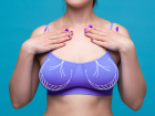 Where is the best country to get a breast reduction? Best reductions costs in �stanbul, T�rkiye