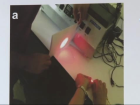Yerli ve Milli Lazer Cihaz� ile 4 Ayr� Hastal�k Tedavi Ediliyor
