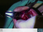 Yontma Tekni�i - Dr.rinoplasti - Op. Dr. Mazhar �elikoyar