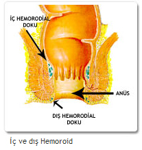 Hemoroid