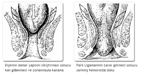 Hemoroid