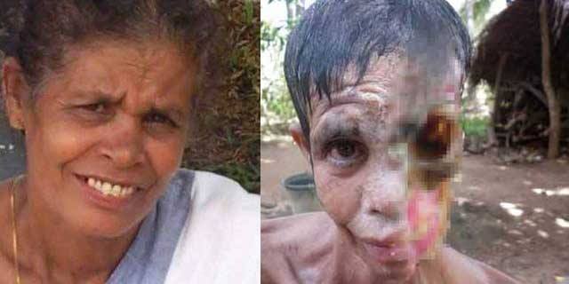 Et Yiyen Bakteri Türkiye�de!